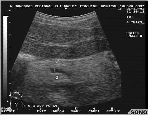 Новости про - Повышенная эхогенность паренхимы печени и расшифровка узи