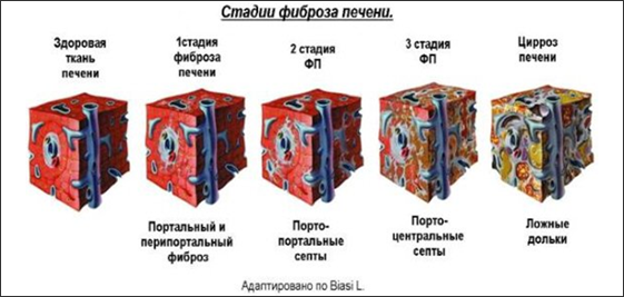 Новости про - Можно ли вылечить фиброзные изменения печени, их признаки и стадии