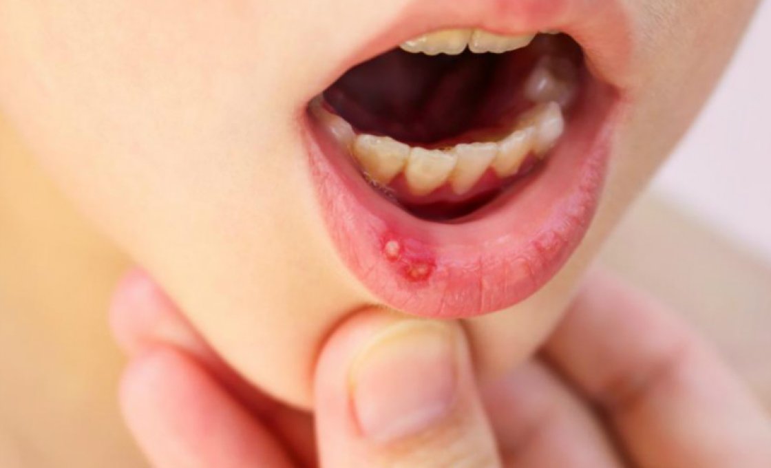 вич в полости рта