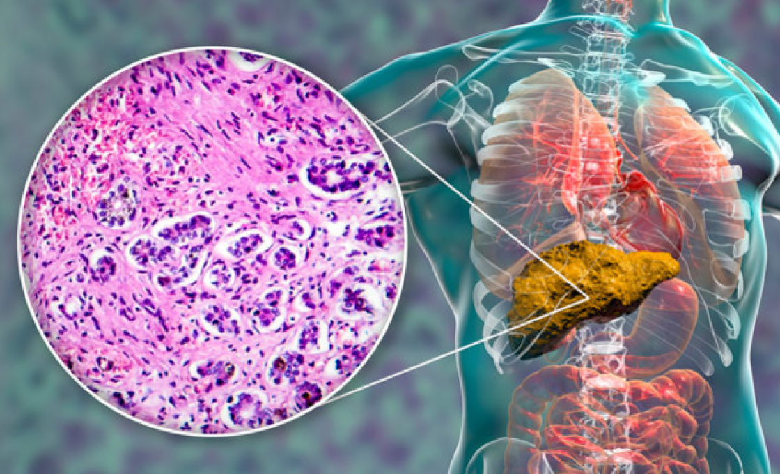 Новости про - Печеночная недостаточность