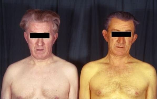 Новости про - Продолжительность жизни с гепатитом С