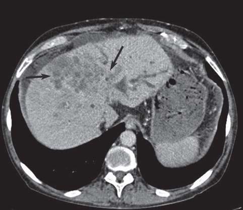 Метастатическое поражение печени, как быстро растёт, проявление и признаки - 1 Новости про - Метастатическое поражение печени, как быстро растёт, проявление и признаки